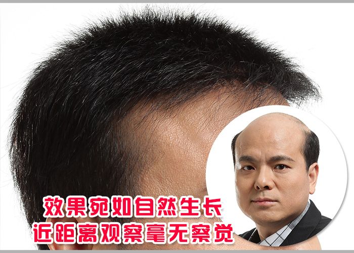 貼在頭頂?shù)募侔l(fā)塊 \