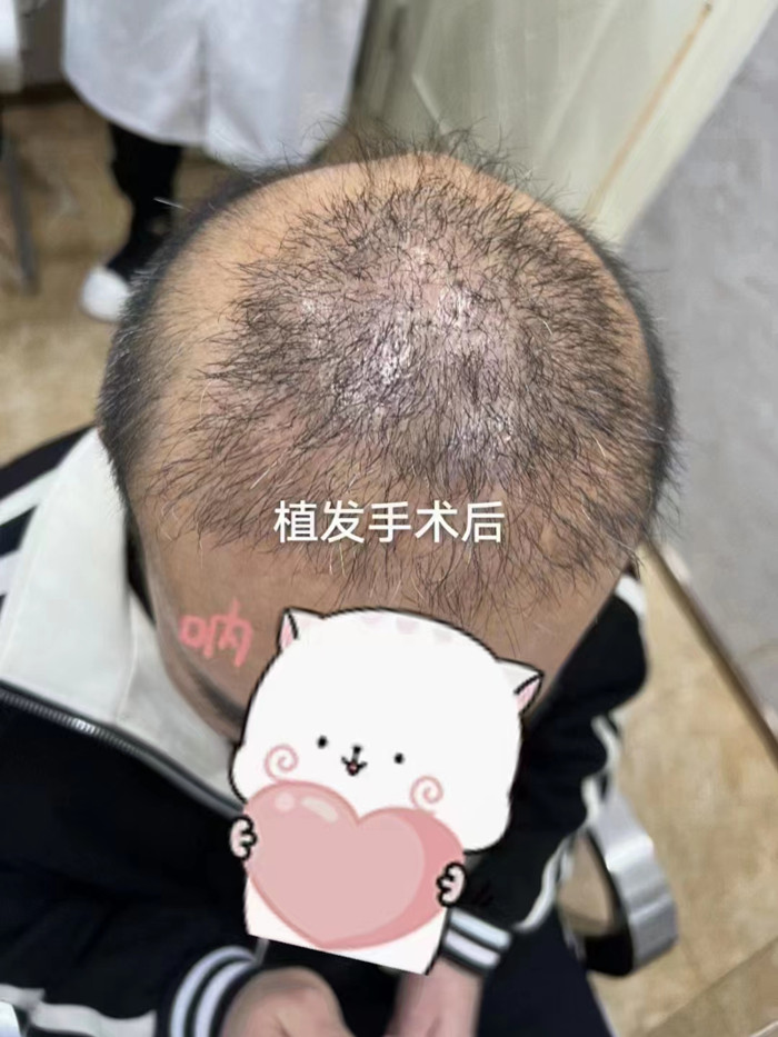 脫發(fā)做補(bǔ)發(fā)多少錢 \