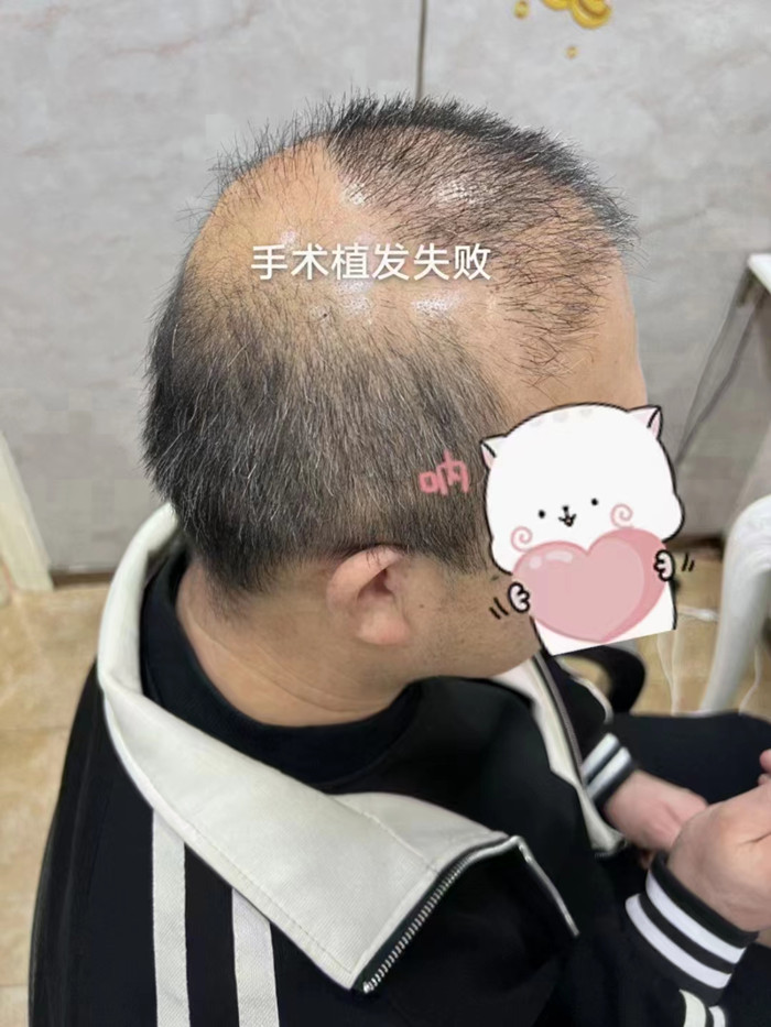 脫發(fā)做補(bǔ)發(fā)多少錢 \