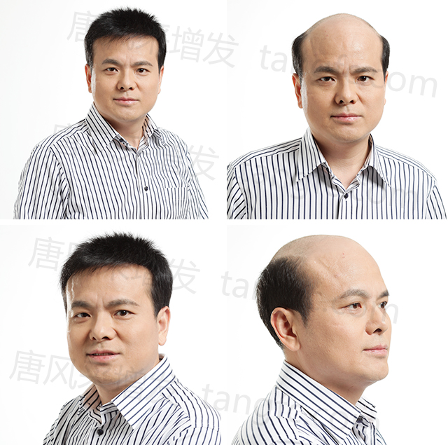 仿生長(zhǎng)無(wú)痕假發(fā) \