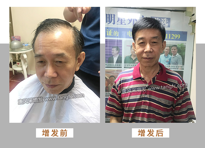 遮白發(fā)遮禿的局部假發(fā)片 \