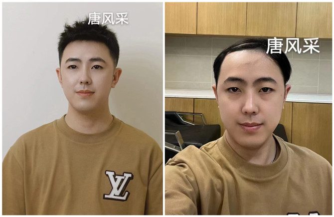 無(wú)痕增發(fā) \