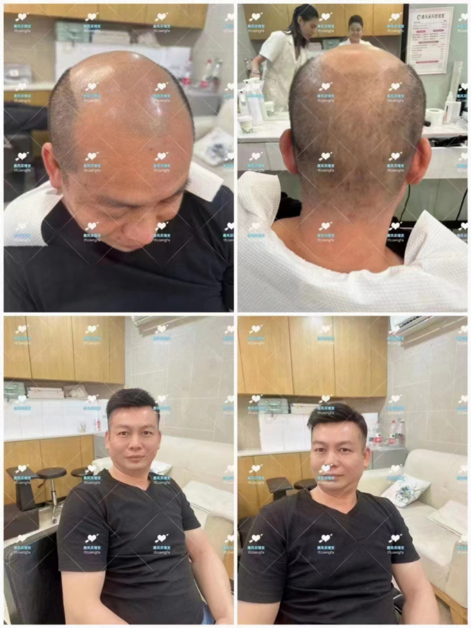 變高的發(fā)際線 \