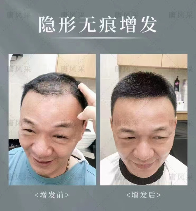 變高的發(fā)際線 \