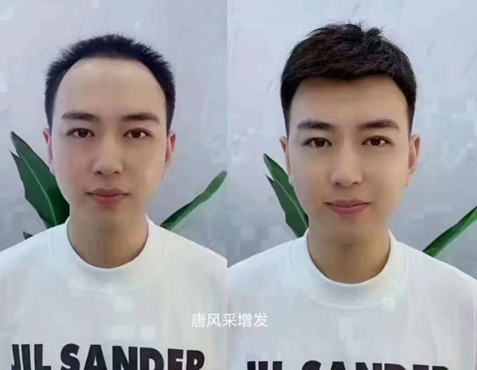 頭頂假發(fā)片 \