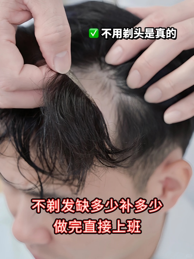 深圳假發(fā),發(fā)際線后退 \