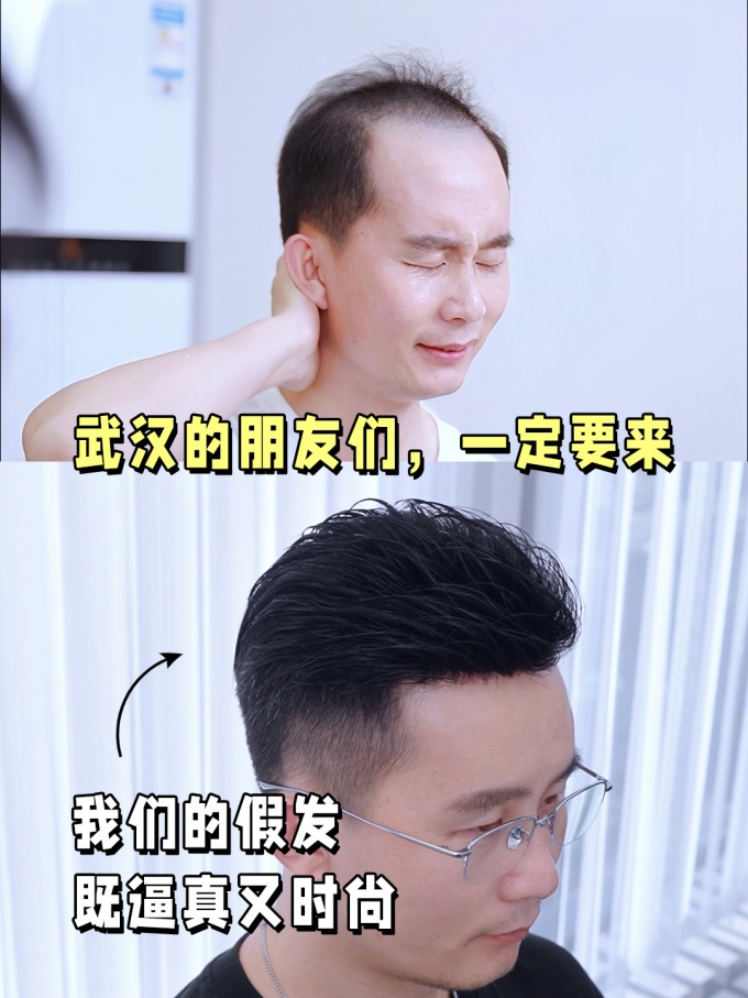 m發(fā)際線,謝頂不用愁,武漢假發(fā) \